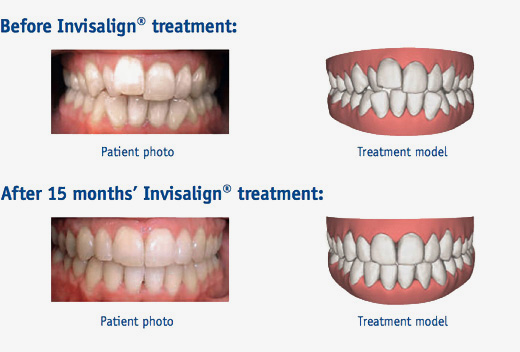 invisalign treatment Before and After