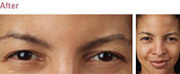 Anti-Wrinkle Treatment After