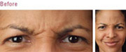 Anti-Wrinkle Treatment Before
